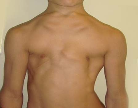 Jeune Sendromu